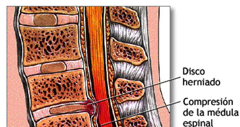 Sabes qu es la hernia de disco